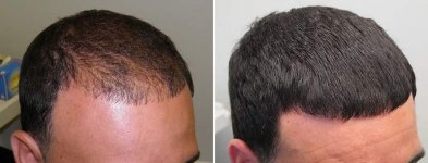 Hair-Transplant-Complications.jpg Hair-Transplant-Complications.jpg